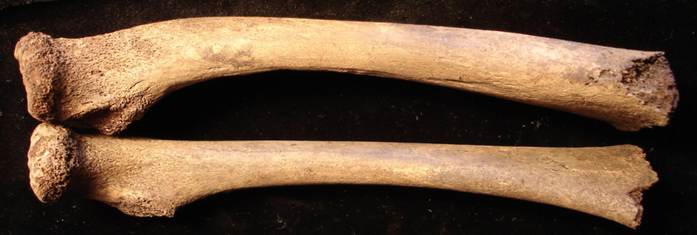 child with rickets from Petersone-Gordina et al. 2013